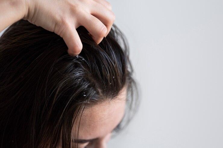 Mengapa Rambut Berkutu? Ini Penyebab dan Cara Mengatasinya
