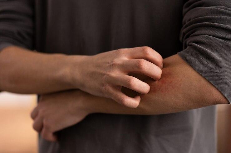 8 Langkah Perawatan Pagi untuk Penderita Psoriasis