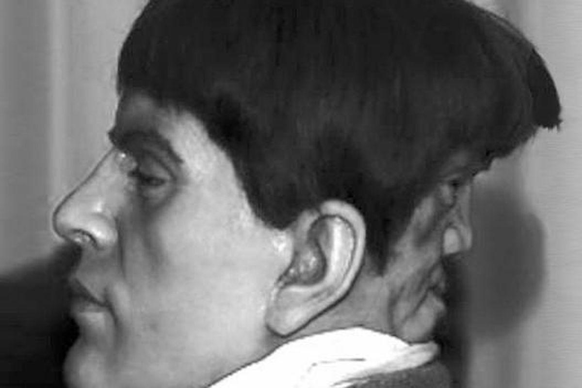 Kisah Mengerikan Edward Mordrake, Pria yang Memiliki Dua Wajah