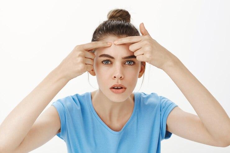 5 Cara Mengatasi Jerawat di Dahi dengan Efektif