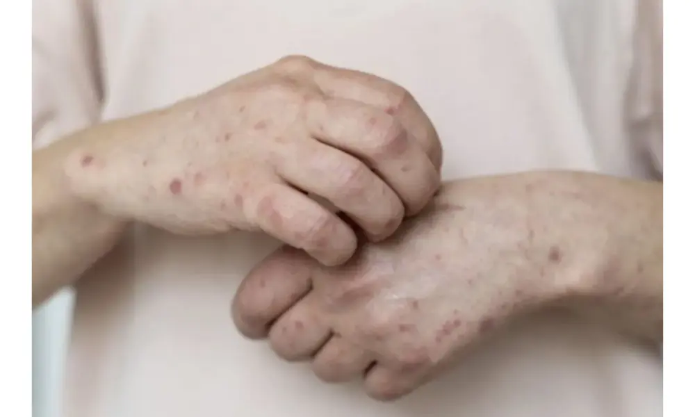 Kemenkes Terima Notifikasi Australia Soal Kasus Campak dengan Riwayat Perjalanan dari Indonesia