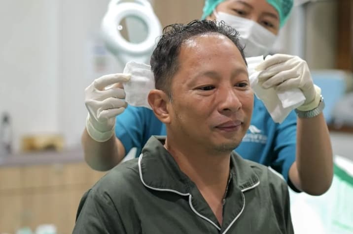 Dokter Ungkap Transplantasi Rambut Perlu Dilakukan Bertahap agar Area Donor Tetap Terjaga