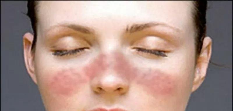 Lupus Sulit Didiagnosis Tapi Bisa Dideteksi Lewat SALURI