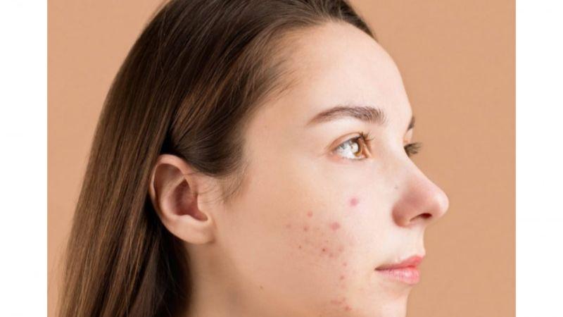 Dokter Ajak Masyarakat Kenali Tanda Ketidakcocokan Perawatan Wajah