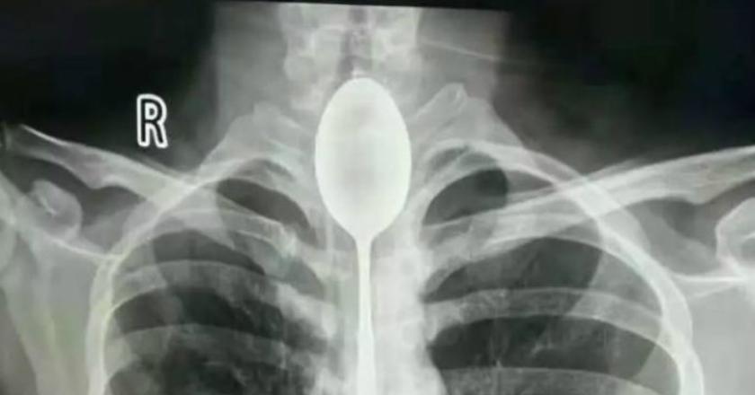 Pria Asal China Hidup dengan Sendok di Kerongkongannya Selama Setahun