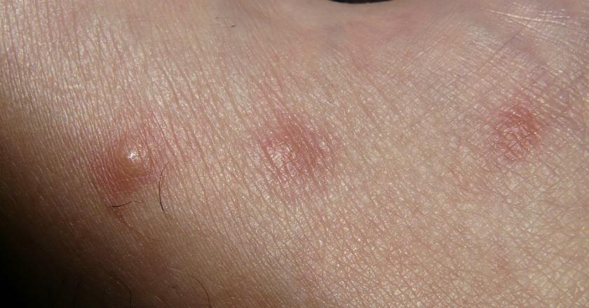 Mengalami Kulit Bersisik Merah? Mungkin Kamu Terkena...