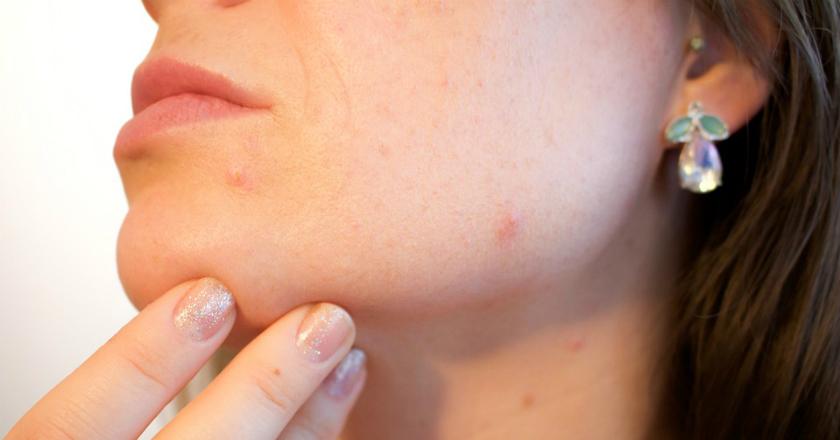 Cocok untuk Kulit Berjerawat, Clear Skin Diet Bisa Bikin Kulit Sehat Alami