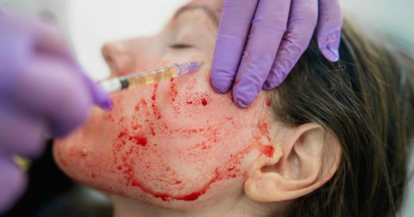Kim Kardashian Menyesal Lakukan 'Vampire Facial', Kamu Masih Berminat?