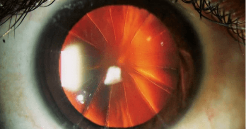 Ngeri! Kornea Mata Wanita Ini Seperti Potongan Pizza