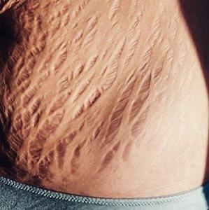 7 Langkah Perangi Selulit